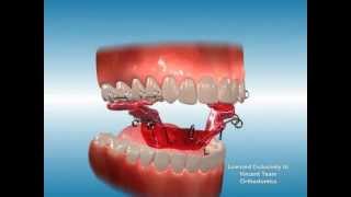 Palatal Expander [upl. by O'Gowan]