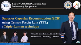 SCRSuperior Capsular Reconstruction ConMed Linvatec CLASS Meeting Cebu ProfBanchaChernchujit [upl. by Trisha]