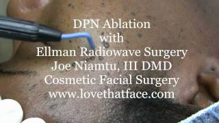 DPN Removal With Ellman Radiowave Surgery by Dr Joe Niamtu [upl. by Nob]