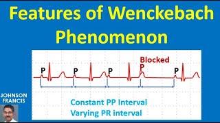 Features of Wenckebach Phenomenon [upl. by Jamima193]