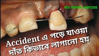 Avulsed tooth How to replace it viral Greenelife [upl. by Adnileb]