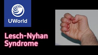 LeschNyhan Syndrome amp purine salvage pathway USMLE Step 1 UWorld Questions Nervous System [upl. by Eelymmij53]