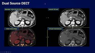 Dual energy CT abdomen [upl. by Wanfried456]