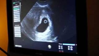 First Ultrasound at 6 weeks 3 days [upl. by Ymma]