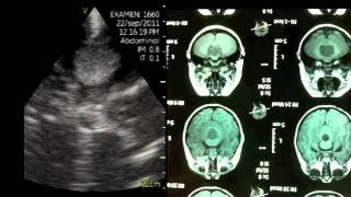 VSCAN Intraoperative quotpocketquot ultrasound Cerebellar Vermis Medulloblastoma [upl. by Hgiellek]