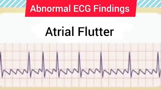 Image Based ECGECG FindingsECG StripsECG Interpretation 1 ecg ekg cardiology shortsviral [upl. by Ocirema]