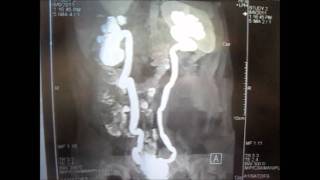 Small Capacity Bladder With Sacculations amp Diverticuli [upl. by Allimrac]