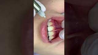 Infiltration anesthesia of the central incisors  Инфильтрационная анестезия центральных резцов [upl. by Ametaf]