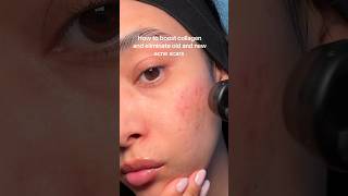 Microneedling results acnescars hyperpigmentation microneedling microneedlingbeforeandafter [upl. by Lellih]