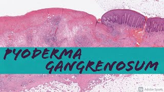 Pyoderma Gangrenosum vs NonSpecific Chronic Ulcer Changes [upl. by Diane-Marie476]