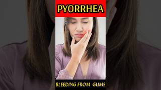 Pyorrhea Treatment At Home  Periodontitis Treatment  pyorrhea symptoms  BY Dr Sanjay Sundriyal [upl. by Sucam]