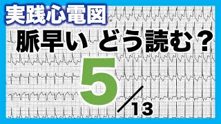 【心電図 読み方 ⑤】頻脈 Tachycardia PSVT 心房頻拍AT 心房粗動AFL [upl. by Notrem]