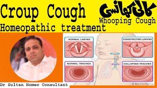 Croup cough and whooping cough treatment in homeopathy [upl. by Esiahc]