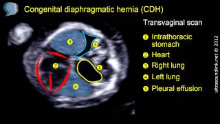 Congenital diaphragmatic hernia CDH at 12 weeks gestation [upl. by Aihsercal437]