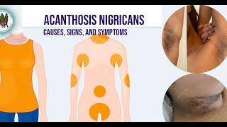 Acanthosis Nigricans Causes Signs and Symptoms [upl. by Namsu]