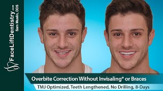 Overbite Correction No Braces or Invisalign® No Surgery in 8Days [upl. by Eenaj]