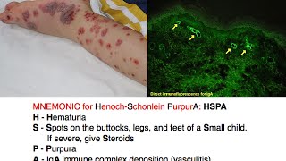 HenochSchonlein Purpura HSP Mnemonic [upl. by Ahsikal]