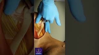 Coracoid Process  Shoulder injection Technique  shorts education [upl. by Kisor]