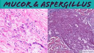 Mucormycosis amp Aspergillosis Angioinvasive Fungal Infection [upl. by Bogoch]