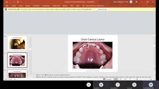 Chapter 13 Dental Caries [upl. by Ardie]