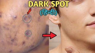 How To Remove DARK SPOTS From Face Naturally  ACNE SCARS BLACK SPOTS ACNE MARKS  Style Saiyan [upl. by Benny]