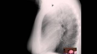 PA and Lat CXR w Thyroid Enlargement DISCUSSION by Radiologist [upl. by Lorne]