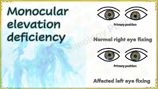 Monocular elevation deficiency  Double elevator palsy  Mini review series 2 [upl. by Airdnahs]