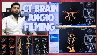 CT SCAN BRAIN ANGIOGRAPHY FILMING PROCESS ON PHILIPS INGENUITY MACHINE SOFTWARE  Circle of willis [upl. by Ylerebmik787]