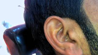 Blackheads in the Ear pimples medication poppingblackheads [upl. by Ecniuq]