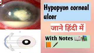 क्या होता है HYPOPYON CORNEAL ULCER  sign  Symptoms  with notes 📖🖋️ Optometry solution [upl. by Corbie]