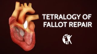 Tetralogy of Fallot Repair  Cincinnati Childrens [upl. by Leahcimsemaj905]