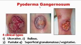 Pyoderma gangernosum [upl. by Faythe]