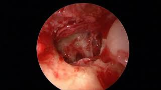 Endoscopic Transcanal Excision of Otic Capsule Schwannoma [upl. by Atoked]