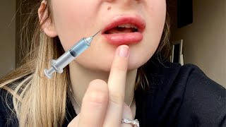 Getting 1ml of lip filler on thin lips [upl. by Narda267]