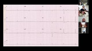 Arrhythmia Basics in ER Part 23 Junctional and Ventricular arrhythmias [upl. by Isahella]