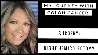 My Journey With Colon Cancer  Episode 3  Colon Resection Surgery [upl. by Eiramasil]