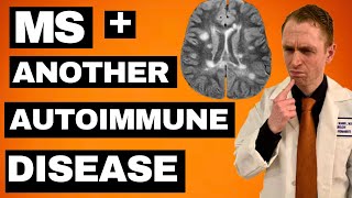 MS  Another Autoimmune Disease Treatment Options [upl. by Zul]