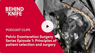 Pelvic Exenteration Surgery Series Episode 1 Principles of patient selection and surgery [upl. by Anisirhc726]