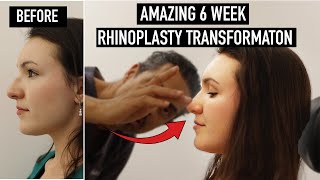 Amazing 6 Week Rhinoplasty Transformation Journey  Dr Julian De Silva [upl. by Hartzel]