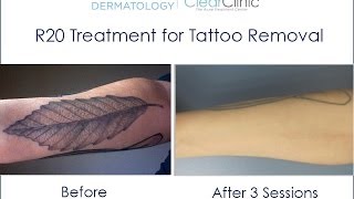 R20 Laser Tattoo Removal Technique [upl. by Enneire948]