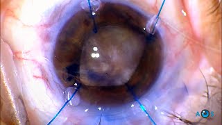 Be ready From Phaco to Intracapsular Cataract Extraction dense phacodonesis cataract surgery [upl. by Hcardahs121]