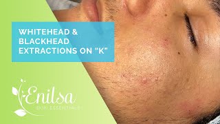 Enilsa is back Whitehead amp Blackhead Extractions on quotKquot  Part 1 [upl. by Ailahk]