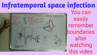 Infratemporal space infection [upl. by Robert]