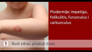 Piodermije impetigo folikulitis furunculus i carbunculus [upl. by Yffub]