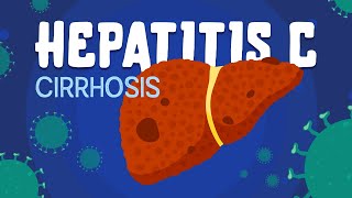 Hepatitis C amp Cirrhosis  symptoms diagnosis amp treatment [upl. by Alemak510]