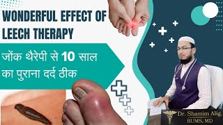 How to Manage Gout Pain The Complete Guide leechtherapy [upl. by Fin264]