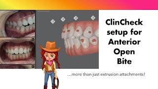 Invisalign ClinCheck  Anterior Open bite [upl. by Furie]