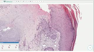 Chondrodermatitis Nodularis Helicis  Histopathology [upl. by Oelc]