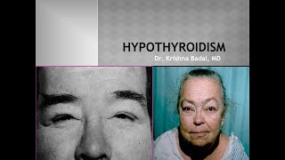 Hypothyroidism Myxedema [upl. by Kiri]