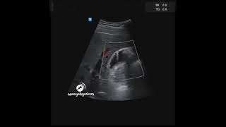 Gallbladder Adenomyomatosis [upl. by Shimkus]